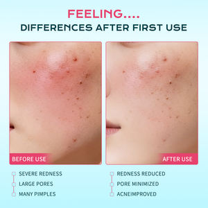 Almohadillas de algodón para eliminar el acné con ácido salicílico de marca privada IREV, 80 tabletas, hidratantes y calmantes para la piel con acné, almohadillas de algodón OEM para limpieza de la piel. - Product Image 5