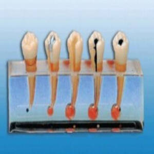 Modèle de science médicale BIX-L1011 Processus pathologique de la carie dentaire Pulpite Racine Abcès Maladie endodontique Modèle clinique - Product Image 2