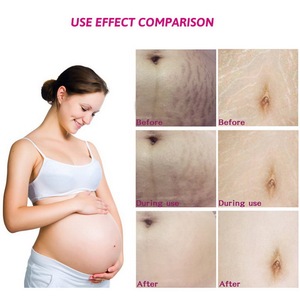 Nhãn Hiệu Riêng Tất Cả Da Tự Nhiên Toning Dầu Chăm Sóc Da Mang Thai An Toàn <span class=keywords><strong>Stretch</strong></span> <span class=keywords><strong>Marks</strong></span> Loại Bỏ Kem - Product Image 3