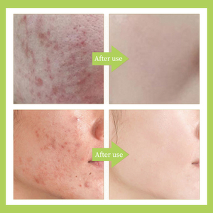 Beauté Hôte Fruit Acide Sérum Visage Rajeunissant Peau Entretien Du Visage Rétrécir Les Pores Raffermissant Sérum Anti Acné Soins De La Peau - Product Image 5