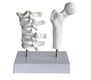 แบบจำลองพยาธิวิทยาโรคกระดูกพรุน แบบจำลองกระดูกต้นขาและกระดูกสันหลังส่วนเอว แบบจำลองพยาธิวิทยาโรคกระดูกเสื่อม 4 ขั้นตอน - Product Image 4