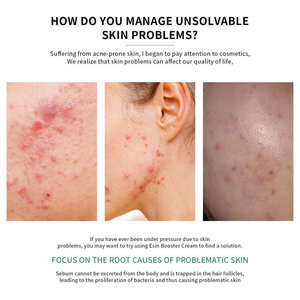 Crème Booster Anti-Acné Personnalisée à la Centella Asiatica <span class=keywords><strong>pour</strong></span> Peaux Grasses, Extrait d'Arbre à Thé, Baume Hydratant Éliminateur de Cicatrices d'Acné - Product Image 3