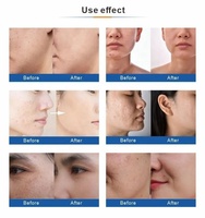 Appareil professionnel d'hydrodermabrasion avec jet d'oxygène, soin du visage et analyseur de peau