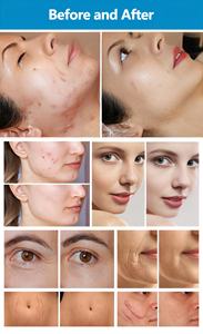 Appareil de beauté pour la restauration de la peau au CO2 fractionné avec 4 modes de coupe pour le traitement des cicatrices et des pigments - Product Image 6