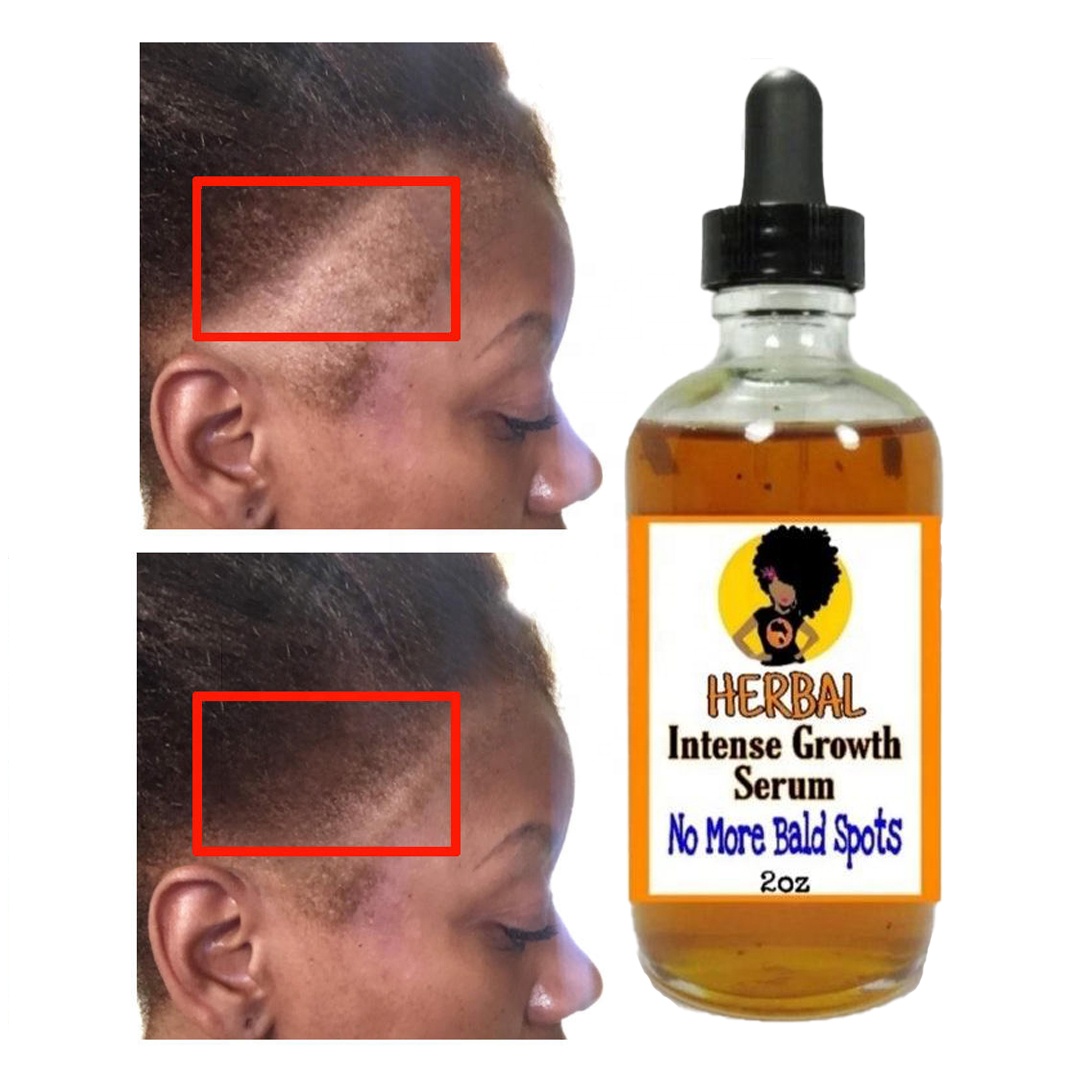 Горячая Распродажа, фирменная торговая марка, 100% натуральная формула, масло для волос, сыворотка для роста густых волос с черными семенами, сыворотка для роста волос