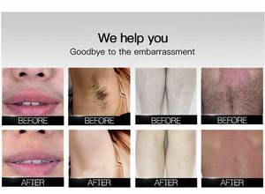 Bán Máy Laser Tẩy Lông <span class=keywords><strong>Diode</strong></span> 808Nm 2 Trong <span class=keywords><strong>1</strong></span> Lightsheer Máy Tẩy Lông Bằng Laser - Product Image 3