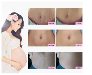 OEM label privé crème à base de plantes pour vergetures et cicatrices lotion exfoliante pour le corps avec glycérine pour le ventre - Product Image 5