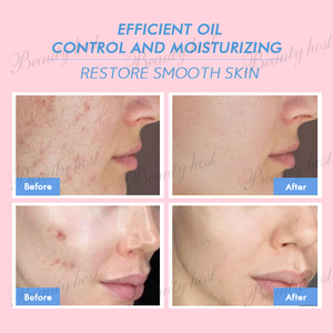 Kit Facial OEM/ODM Beauty Host de 2 Piezas, Refrescante y Control de Grasa, Antiacné, Limpiador Facial de 100g, Crema Facial de 50g, Set de Cuidado Facial Antiacné - Product Image 4