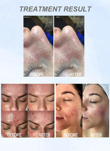 2023 Spa Beautician Like 14 in 1 Microdermabrasion Diamond Dermabrasion Peel Tip Hydra Skin Facial Machine for Blackhead Remover - Product Image 6