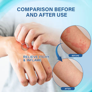 Sumifun, лидер продаж, крутая Антибактериальная противовоспалительная мазь для кожи, 2025 дерматитная мазь, 20 г - Product Image 4