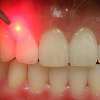 Équipement dentaire portable à diode laser de faible puissance 30 W, machine de blanchiment des dents au laser 980 nm