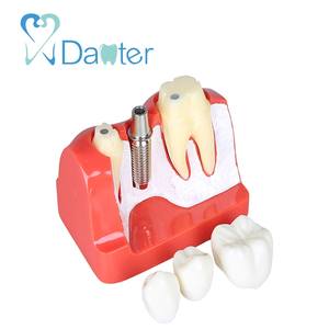 4 volte la scienza medica impianto dentale modello porcellana denti amovibile corona ponte impiallacciature per l'insegnamento di materiale plastico - Product Image 3