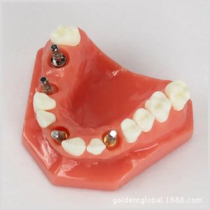 Modèle d'implant dentaire Dt 1:1, modèle anatomique en résine pour la science médicale, pour usage domestique - Product Image 3