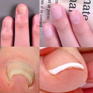 OEM ODM, Autocollant Anti-Curling pour la Correction des Ongles Incarnés, en Tissu Élastique - Product Image 6