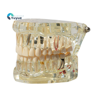 Implant dentaire détachable et modèle de résine de dent pathologique soins bucco-dentaires et démonstration de couronne de pont en PVC pour la science médicale