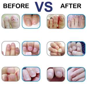 Anti hongos <span class=keywords><strong>uñas</strong></span> crema mata hongos <span class=keywords><strong>en</strong></span> <span class=keywords><strong>las</strong></span> <span class=keywords><strong>uñas</strong></span> de los pies y <span class=keywords><strong>uñas</strong></span> reparaciones decoloración frágil y <span class=keywords><strong>las</strong></span> <span class=keywords><strong>uñas</strong></span> rotas - Product Image 4