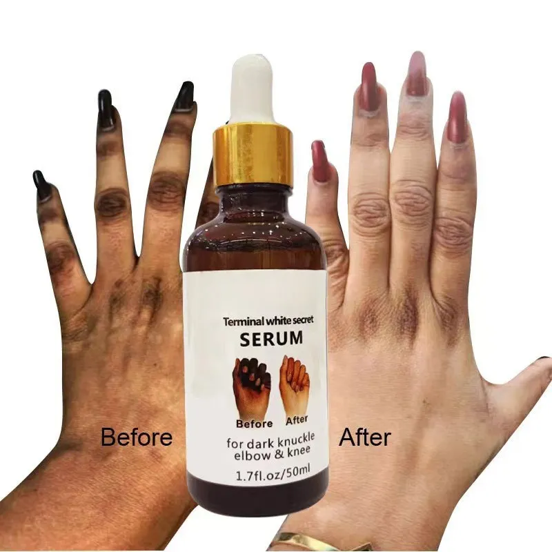 Snelle Whitening Serum Pigmentatie Correctoren Hand Knokkel Ellebogen Knie Intense Vlekken Remover Serum