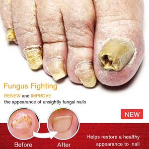 Piedi cura essenza Anti infezione paronichia piede onicomicosi fungo fungo rimozione Gel <span class=keywords><strong>per</strong></span> unghie fungine penna <span class=keywords><strong>per</strong></span> trattamento fungino - Product Image 6