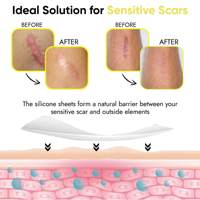 Pansement adhésif transparent en silicone de haute qualité pour cicatrices, plaies chirurgicales, acné, chéloïdes, brûlures, soins de beauté et personnels