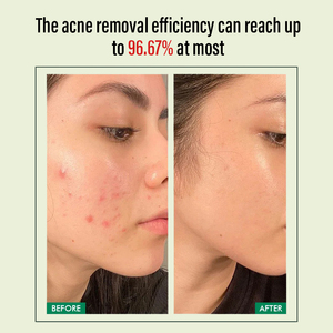 Крем для лица с натуральной салициловой кислотой и нейтрофильными клетками Private Label, против акне, для чувствительной кожи, увлажняющий гель-крем для ухода за кожей - Product Image 5