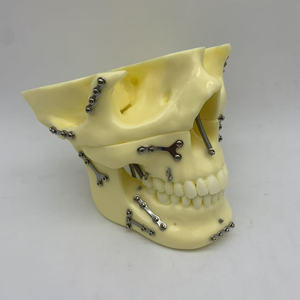 <span class=keywords><strong>Fracture</strong></span> osseuse fixe avec plaque de titane et modèle de <span class=keywords><strong>crâne</strong></span> dentaire Ortho Implant - Product Image 2