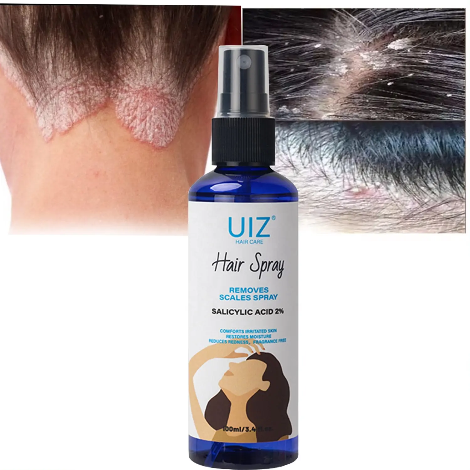 Natural Irritated Scalp Psoriasis Treatment Spray Salicylic Acid 2% For Redness Scales Flakes Cracks Itchiness Relief
