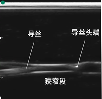 Modelo de estenosis de fístula arteriovenosa guiado por ultrasonido - Membrana de estoma para entrenamiento de dilatación con balón de anastomosis PTA en modo B
