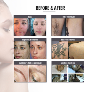 2023 công nghệ mới 3 trong 1 Máy tẩy lông <span class=keywords><strong>IPL</strong></span> OPT Elight Máy làm đẹp - Product Image 6