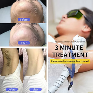 स डायोड लेजर बालों को हटाने मशीन लेजर डायोड 8088nnm 3 तरंगें 755 808 1064 लेजर डायोड हेयर हटाने उत्पाद उपकरण उपकरण उपकरण उपकरण - Product Image 5