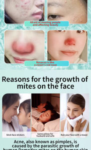 Crème réparatrice <span class=keywords><strong>pour</strong></span> <span class=keywords><strong>le</strong></span> <span class=keywords><strong>visage</strong></span>, soin de la peau, anti-acné à base de plantes, <span class=keywords><strong>pour</strong></span> hydrater et éliminer précisément l'acné - Product Image 4