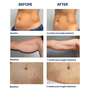 Máquina de Masaje Corporal Profesional Aston 2026 de Acero Inoxidable con Rodillos para Drenaje Linfático y Luz Infrarroja para la Celulitis - Product Image 6