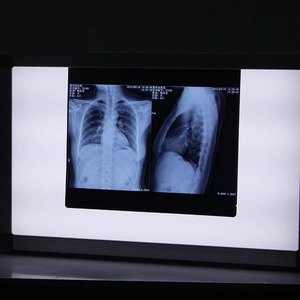 Bệnh viện ngoại trú có thể sử dụng đèn LED siêu mỏng ba lớp phim chiếu sáng cầm tay LED negatoscope - Product Image 5