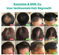 2billion Exos GHK-Cu Polvo Liofilizado para el Crecimiento del Cabello, Solución Profesional Anticaída, Estimulación de Folículos, Tratamiento de Regeneración