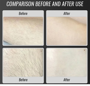 4K Láser de Diodo profesional Depilación Láser de Diodo 755nm 808nm 1064nm permanente 808 máquina de depilación láser de diodo - Product Image 6