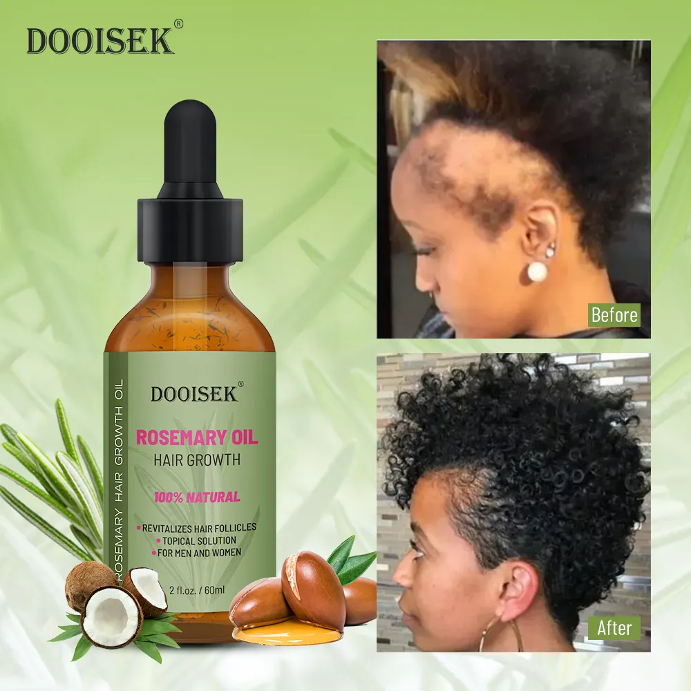 Óleo essencial de alecrim para crescimento capilar, sérum nutritivo para fortalecimento do cabelo, óleo orgânico, de alecrim, para crescimento do cabelo