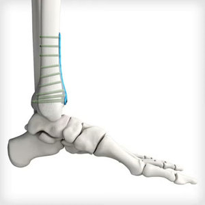 Implantes Ortopédicos de Titanio de Nuevo Diseño en Oferta, Placa para Radio Distal y Únula, Placa Ósea de Ángulo Variable, Implantes Ortopédicos Reutilizables - Product Image 2