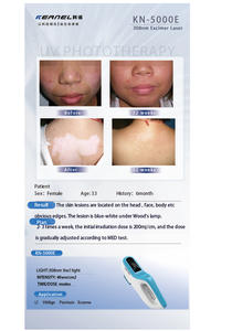 Kernel KN-5000E Derma 308, photothérapie ciblée recommandée par les dermatologues pour le <span class=keywords><strong>traitement</strong></span> du psoriasis, du vitiligo et de l'eczéma - Product Image 2