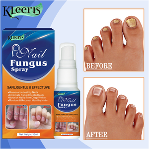 Soins des pieds, herbes naturelles chinoises, 30 ml, meilleur traitement pour les infections fongiques des ongles des pieds et réparation des ongles fongiques - Product Image 2