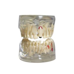 Modelo dental durante el período de dentición alternativa Dentaduras Materiales dentales Modelo de comunicación médico-paciente - Product Image 4
