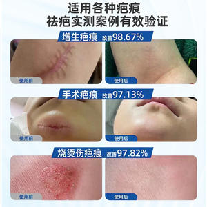 Patch de réparation des cicatrices en silicone médical Wanzijian, boîte de 2 pièces, utilisation post-opératoire - Product Image 5