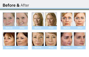 Máquina Facial de Dermoabrasión Skinfiner de Oxígeno de Alta Calidad, Máquina de Rejuvenecimiento de la Piel con Dermoabrasión - Product Image 6