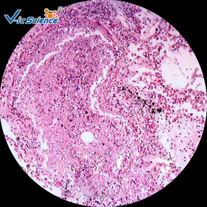 Lung abscess biological section, medical histology, <b>microscope</b> for teaching and research, medical school laboratory. - Product Image 2