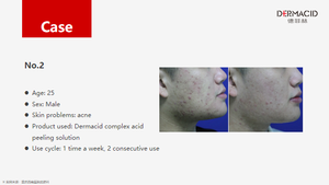 Best Seller Private Label Clinic salone di bellezza usato 5g * 10 tubi Per scatola 35% acidi composti Anti Acne pigmentazione Peeling chimico - Product Image 6