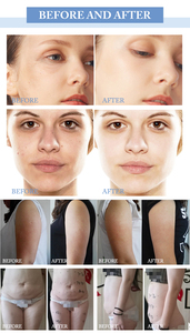 Nouvelle machine de remodelage corporel par aspiration et rouleaux, pour l'élimination de la graisse et l'amincissement Vela. - Product Image 6