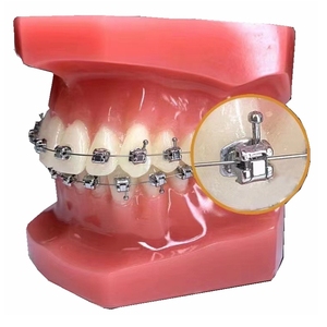 Meistverkaufte Hochwertige Edelstahl Metall Kieferorthopädische Passive Selbstligierende Brackets Manuelle Zahnspangen zum Fabrikpreis - Product Image 2