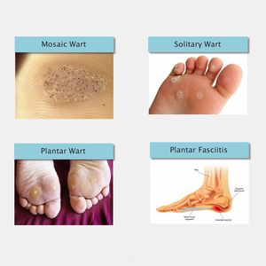 Láser de Diodo Berylas de 810nm y 980nm, Multi-Longitud de Onda, 15W, Clase II, <span class=keywords><strong>para</strong></span> el Tratamiento de <span class=keywords><strong>Hongos</strong></span> <span class=keywords><strong>en</strong></span> <span class=keywords><strong>los</strong></span> <span class=keywords><strong>Pies</strong></span> - Product Image 4