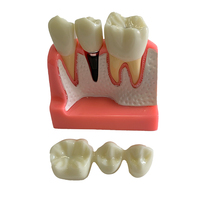 Modèle d'implant dentaire pour la démonstration patiente Modèle de couronne et de pont d'implant dentaire