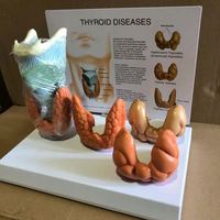 KyrenMed Thyroïde Modèle pathologique Thyroïde Larynx Maladies Modèle éducatif Nodule Goitre Thyroïdite Mastoïde Cancer