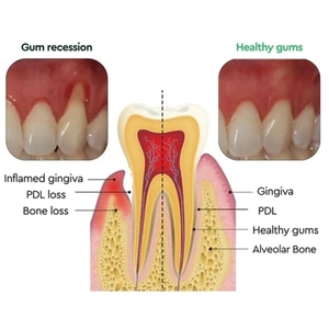 Mousse de 30 ml para Reparación Rápida de Caries, Limpia y Blanquea los <span class=keywords><strong>Dientes</strong></span>, Elimina las Manchas Amarillas de Placa, Gengivas Dañadas, Dolor de Muelas - Product Image 2