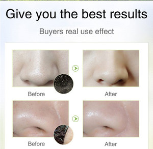 Mặt Nạ Trị Mụn Cho Da Mặt Nhãn Hiệu Riêng Mặt Nạ Lột Mặt Làm Sạch Sâu Và Mặt Nạ Tẩy Mụn Đầu Đen Than Mũi - Product Image 6